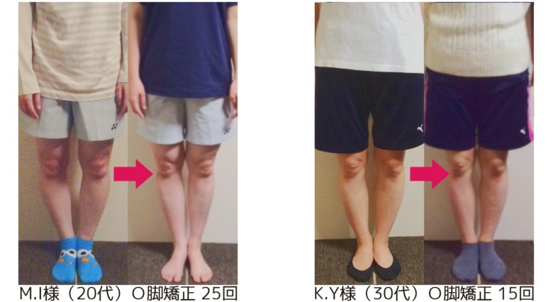 O脚矯正を受けていただいた方の変化のひかっく画像