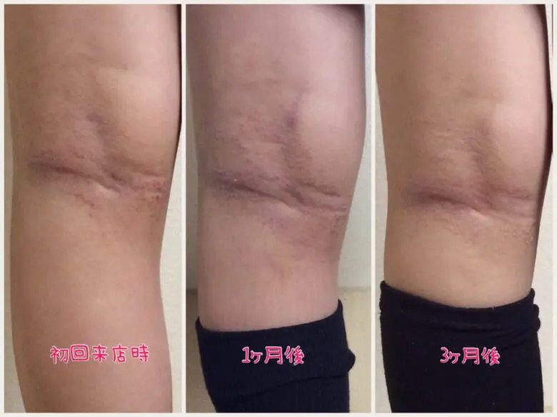 一時的な好転反応の赤みを経てアトピー症状が和らいだ膝裏の経過写真