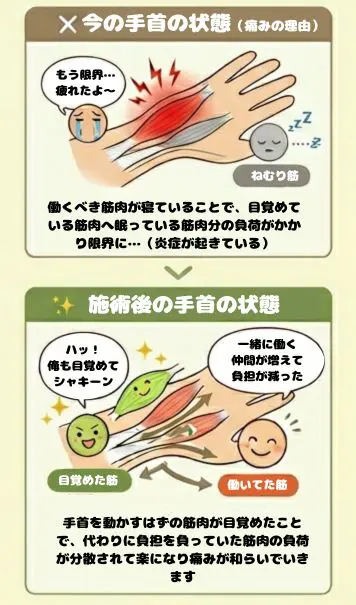 働きすぎて炎症を起こした手首の筋肉が働ける筋肉を施術で起こしたことにより負担が減ったイメージ