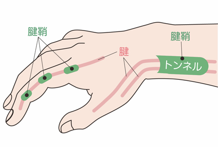手首の腱鞘炎についてどの場所で炎症が起きているのかをわかりやすくした解剖図
