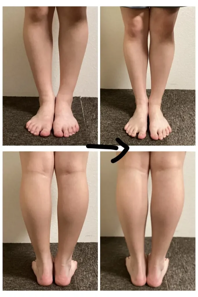 O脚で悩まれていた40代女性、が気が付いたら足を組まなくなったんですというお客様の比較写真