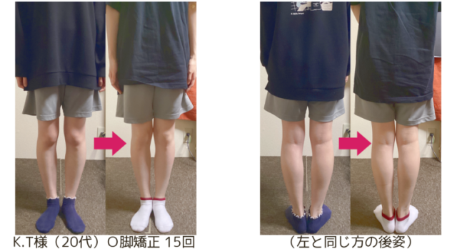 O脚の治し方｜自分で改善できる？整体が必要なケースも解説