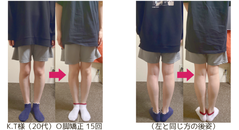 O脚の治し方｜自分で改善できる？整体が必要なケースも解説
