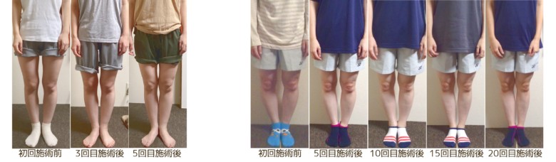 O脚のタイプからおおよその回数による改善の経過画像