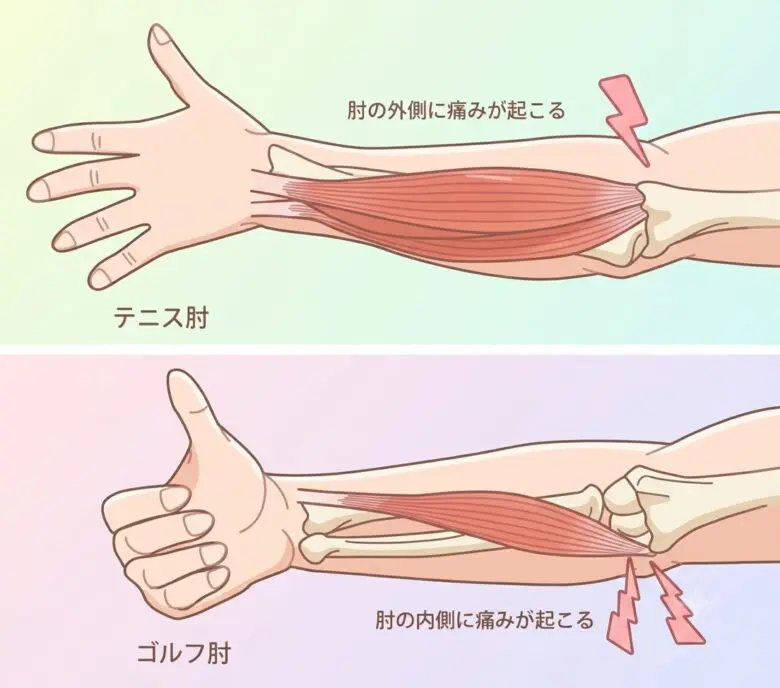 テニス肘は肘の外側、ゴルフ肘は肘の内側に痛みが出ることを図解したもの
